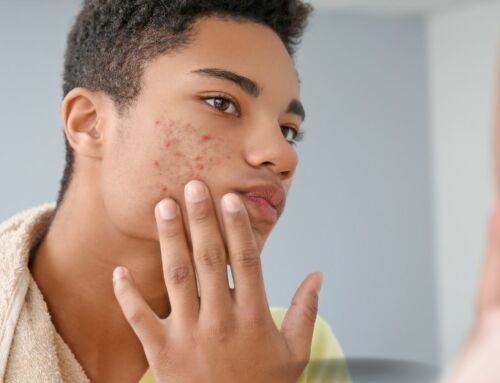 Top Home Remedies for Acne and a Professional Touch