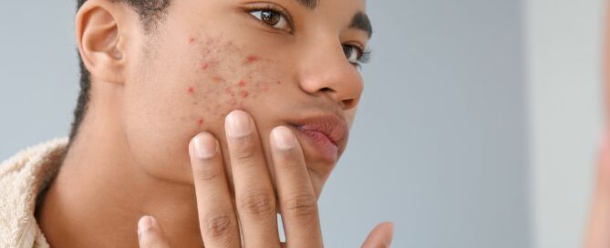 Home Remedies for Acne and a Professional Touch