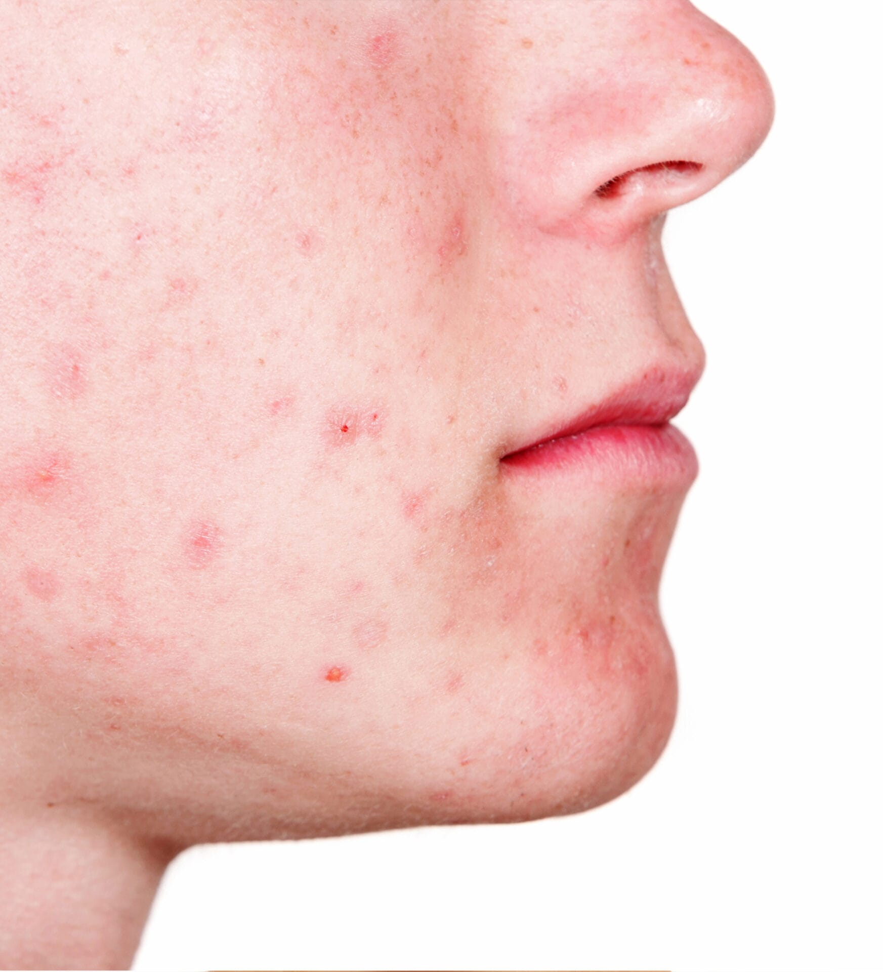 Laser Acne Treatment