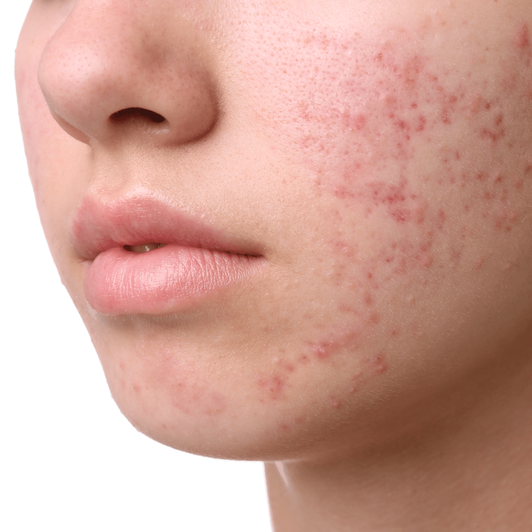 Laser Acne Treatment