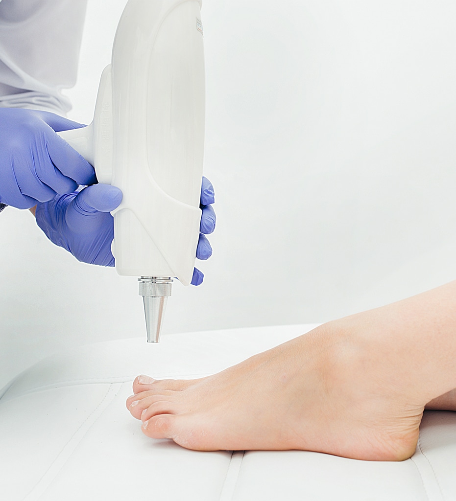 Laser Nail Fungal Removal