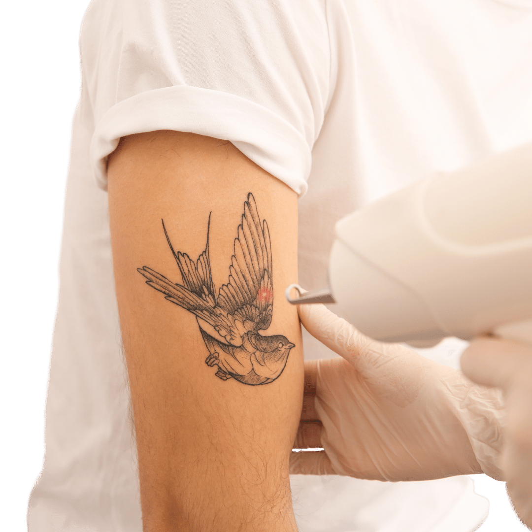 Laser Tattoo Removal