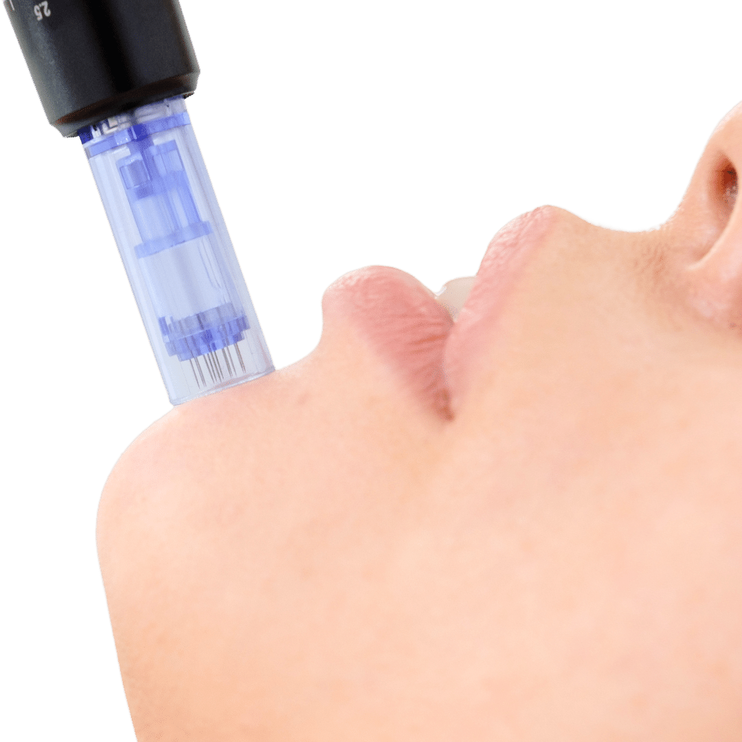 Microneedling