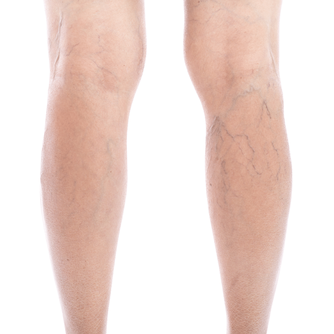 Spider Vein Removal