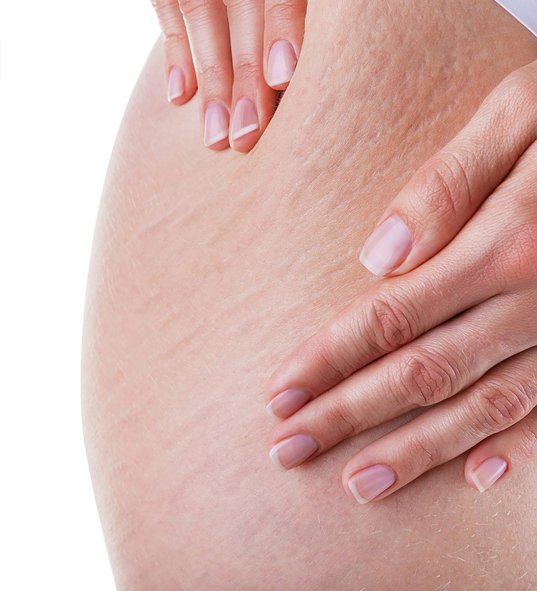 Stretch Mark Reduction