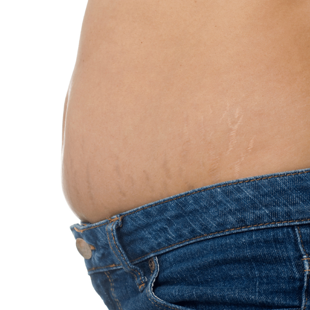 Stretch Mark Reduction